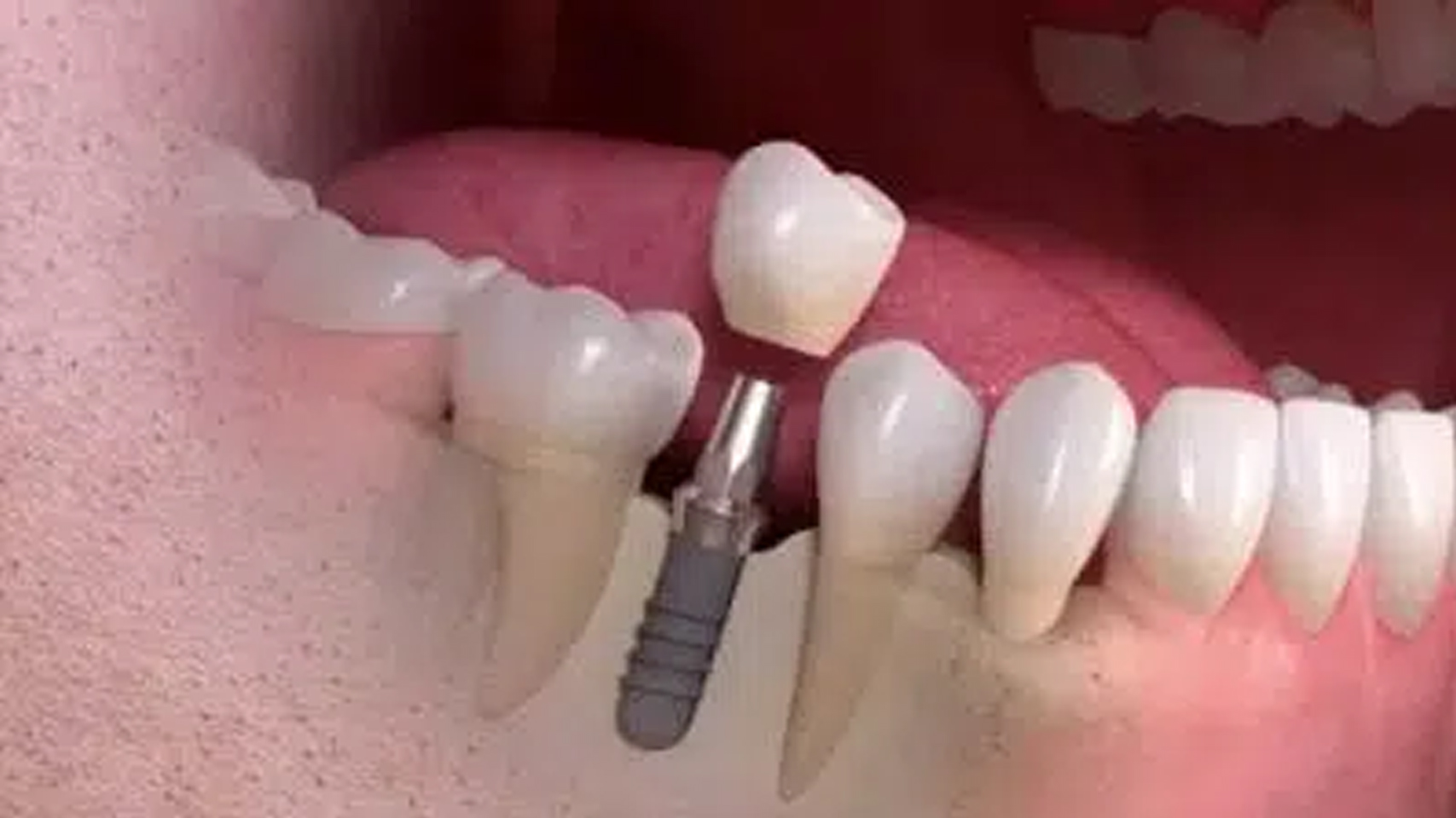 How does Diode Laser help dental implants?