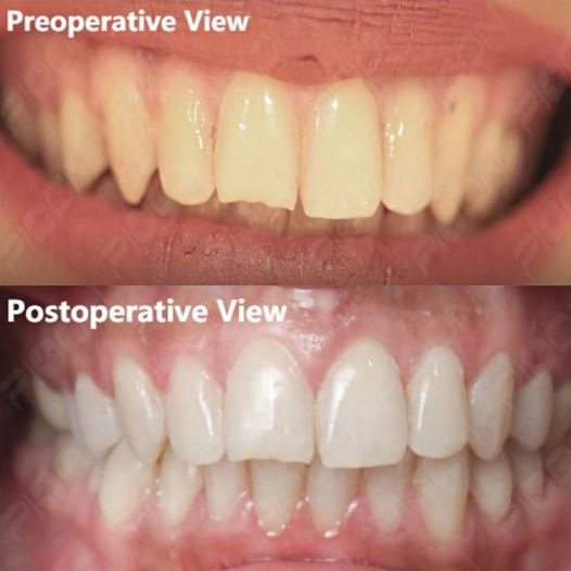 laser-teeth-whitening
