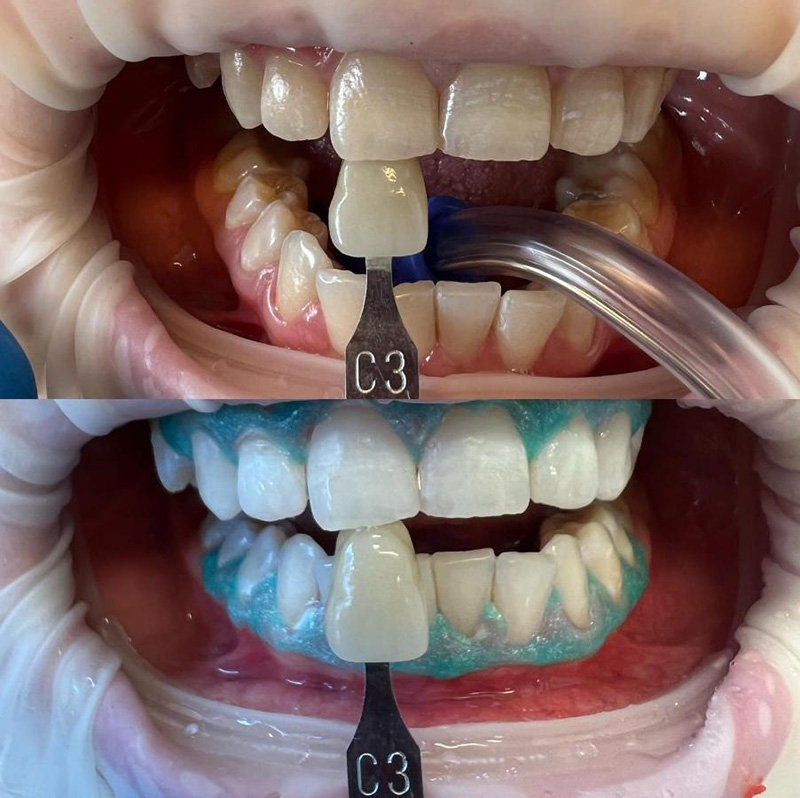 laser-teeth-whitening