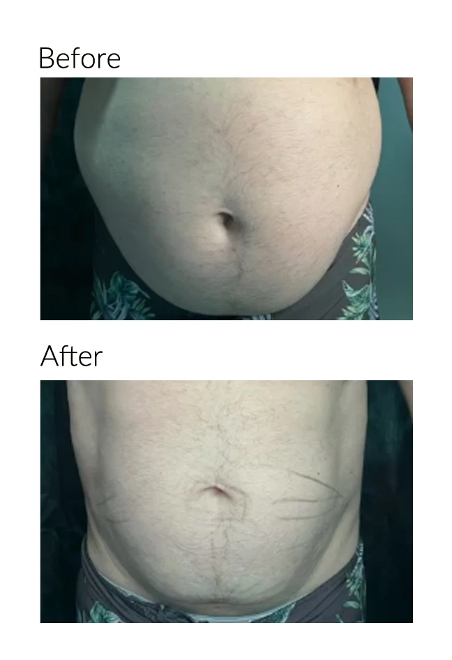 Body Endolift
