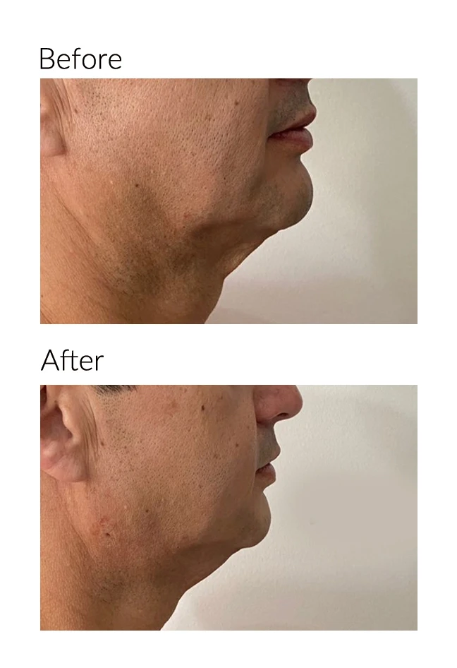 facelift