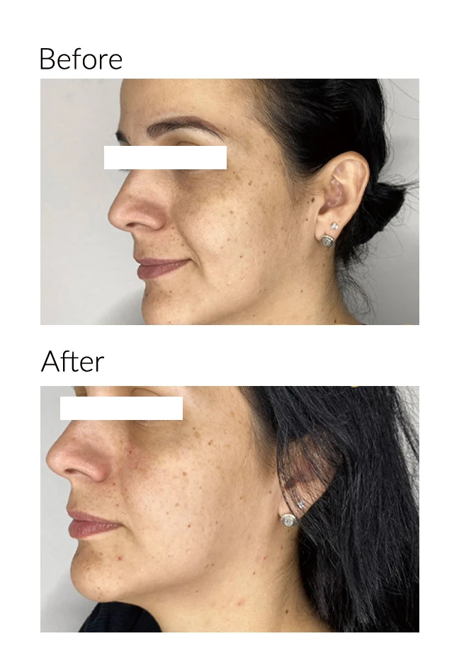 facelift