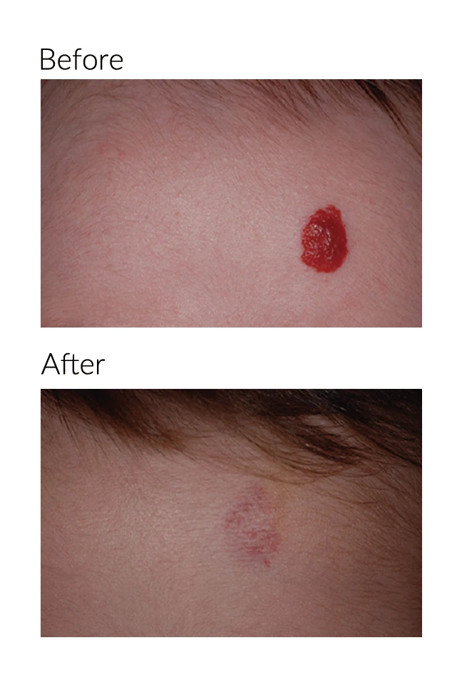 hemangioma