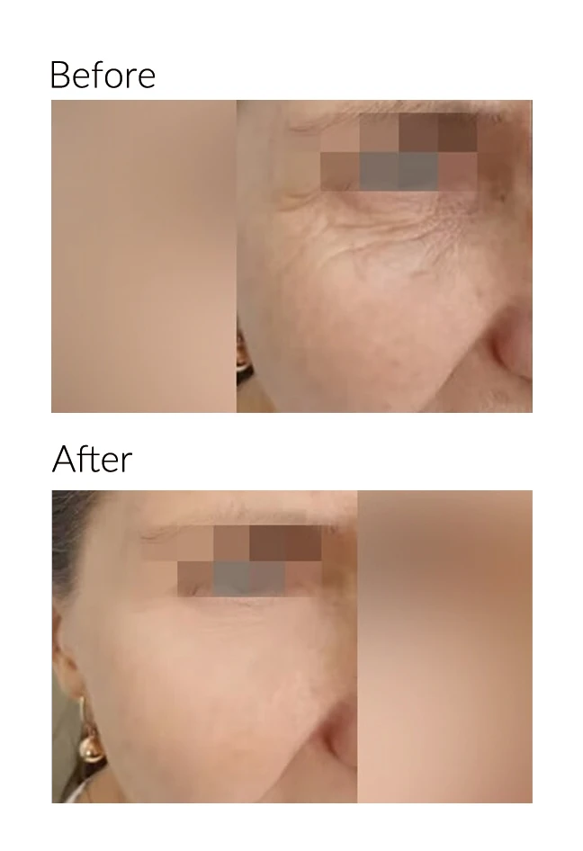 Face Lift
