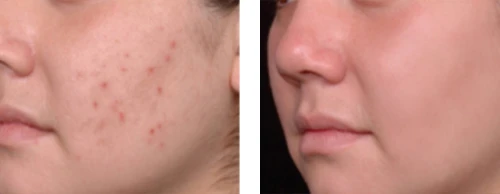 Acne