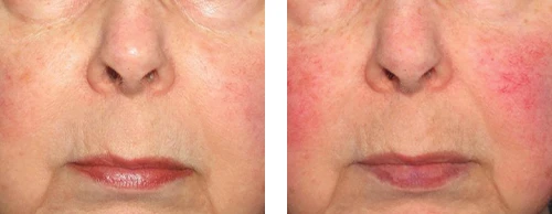 Couperose skin
