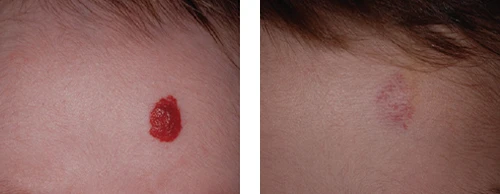 Hemangioma