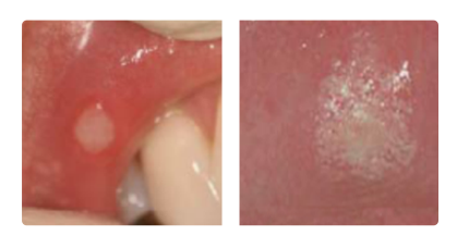 Aphthous Ulcers