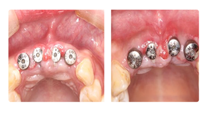 Assisted Peri-lmplantitis