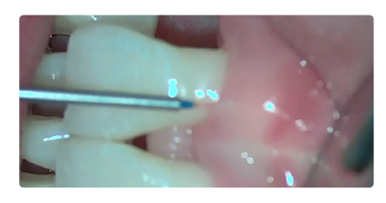 Pocket Sterilization