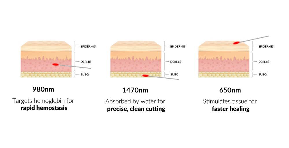 Expanded Triple-Wavelength Surgical Diode Laser