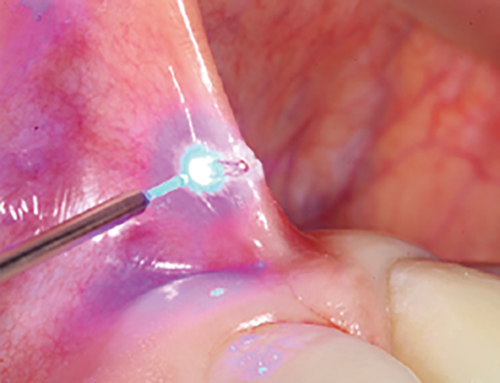 450nm Blue Laser-Faster