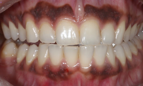 Before Laser Treatment