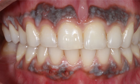 Immediate postoperative view after laser irradiation