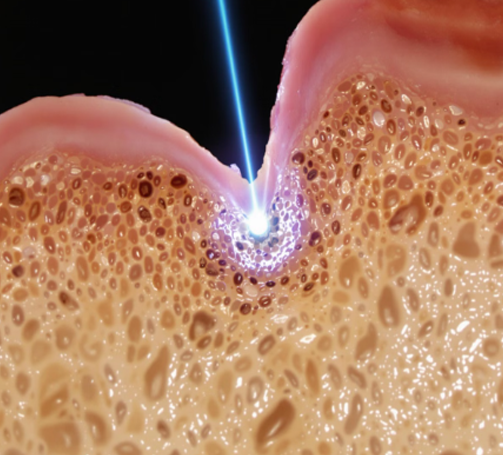 Painless & Non-Invasive