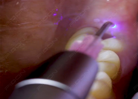 dental laser