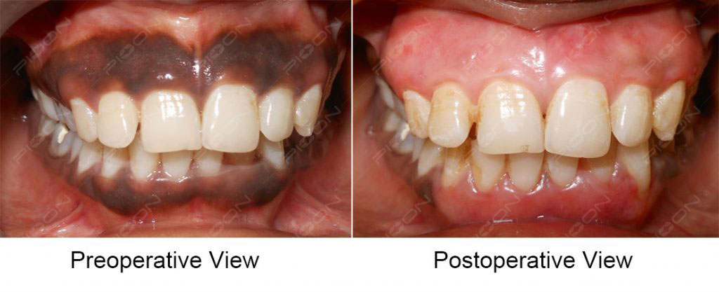 dental laser