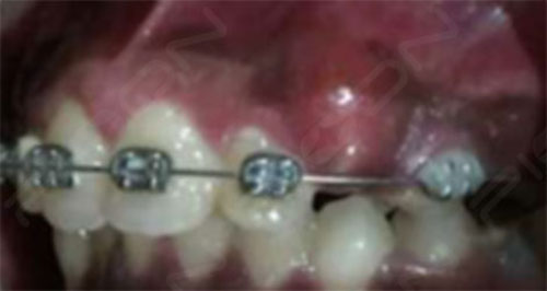 dental laser
