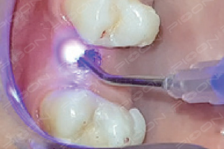 dental laser