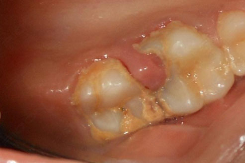 Laser Assisted Excision Of a Gingival Polyps