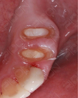 dental-laser1.jpg