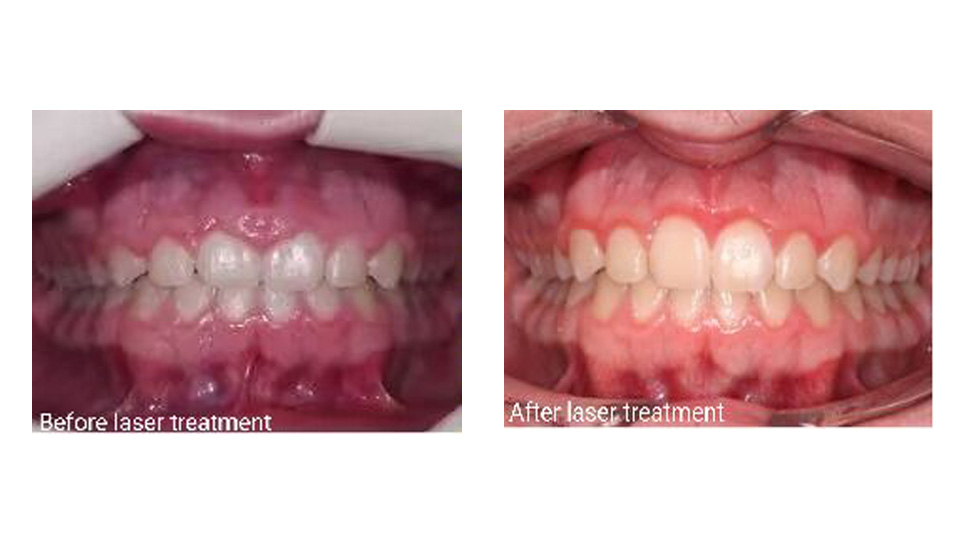 lasers in orthodontics