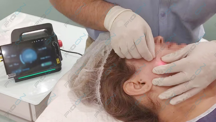 Facial Contouring with Laser