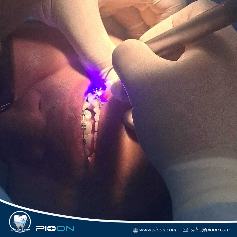 blue dental lasers