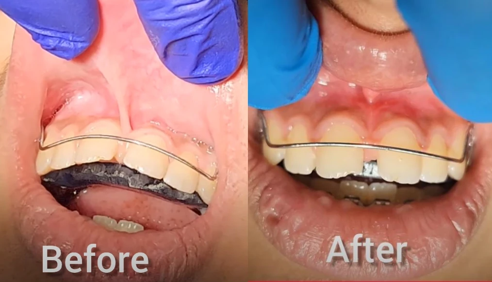 Before and after laser frenectomy treatment using 450nm diode laser