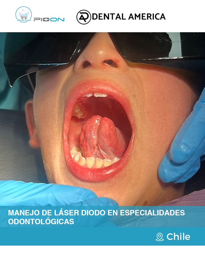 laser dentistry, diode laser training, PIOON, dental education, Chile