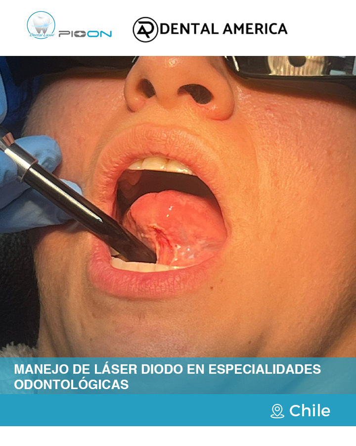 laser dentistry, diode laser training, PIOON, dental education, Chile