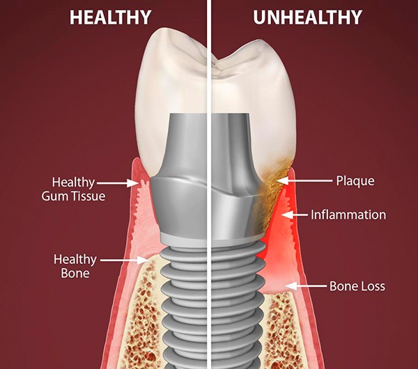 dental-implant-infected.jpeg