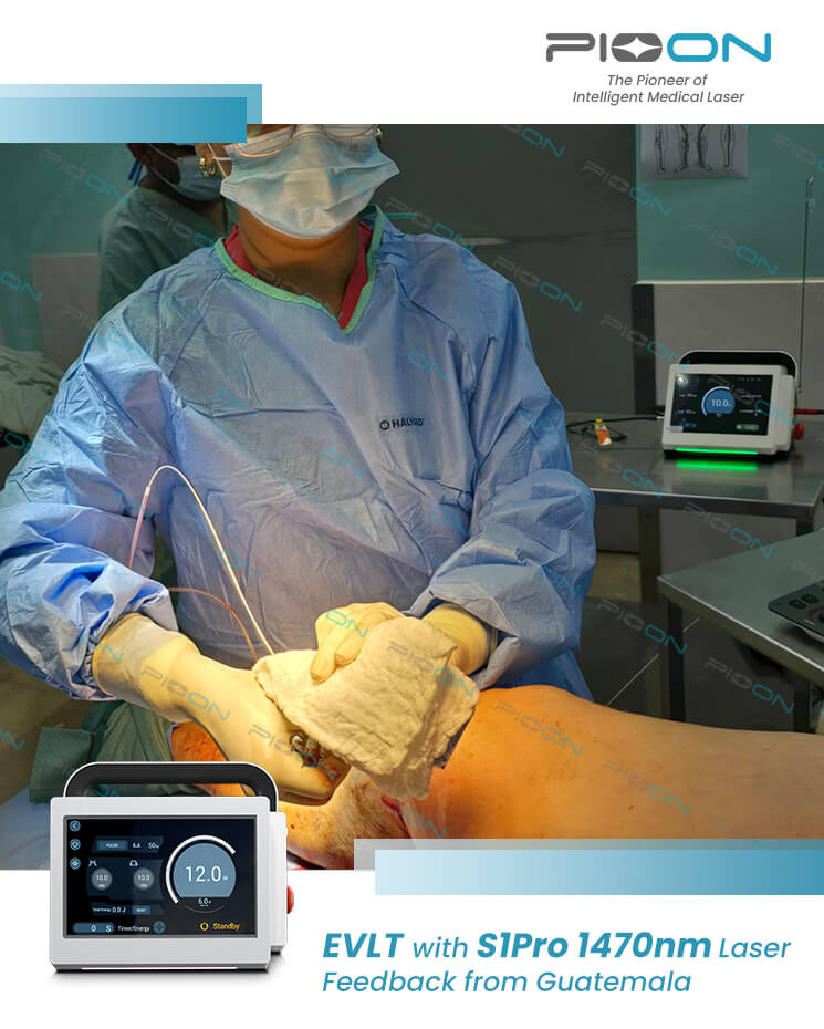 Vascular Surgery laser vein treatment 1470nm wavelength