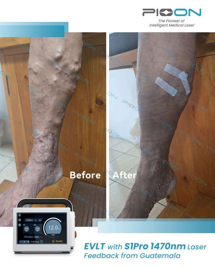 Vascular Surgery laser vein treatment 1470nm wavelength
