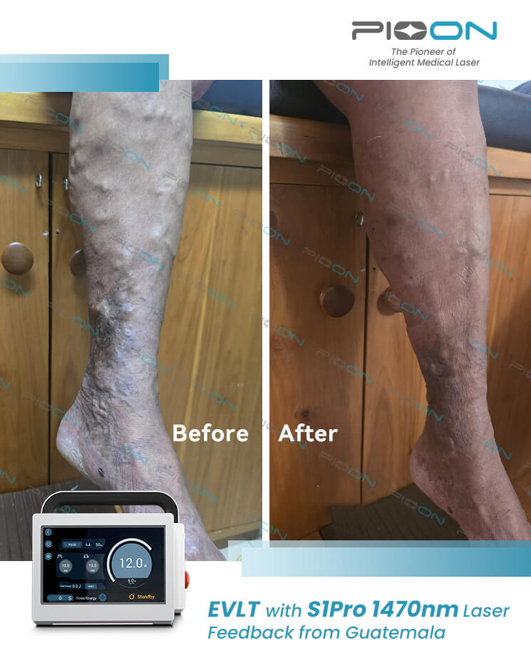 Vascular Surgery laser vein treatment 1470nm wavelength