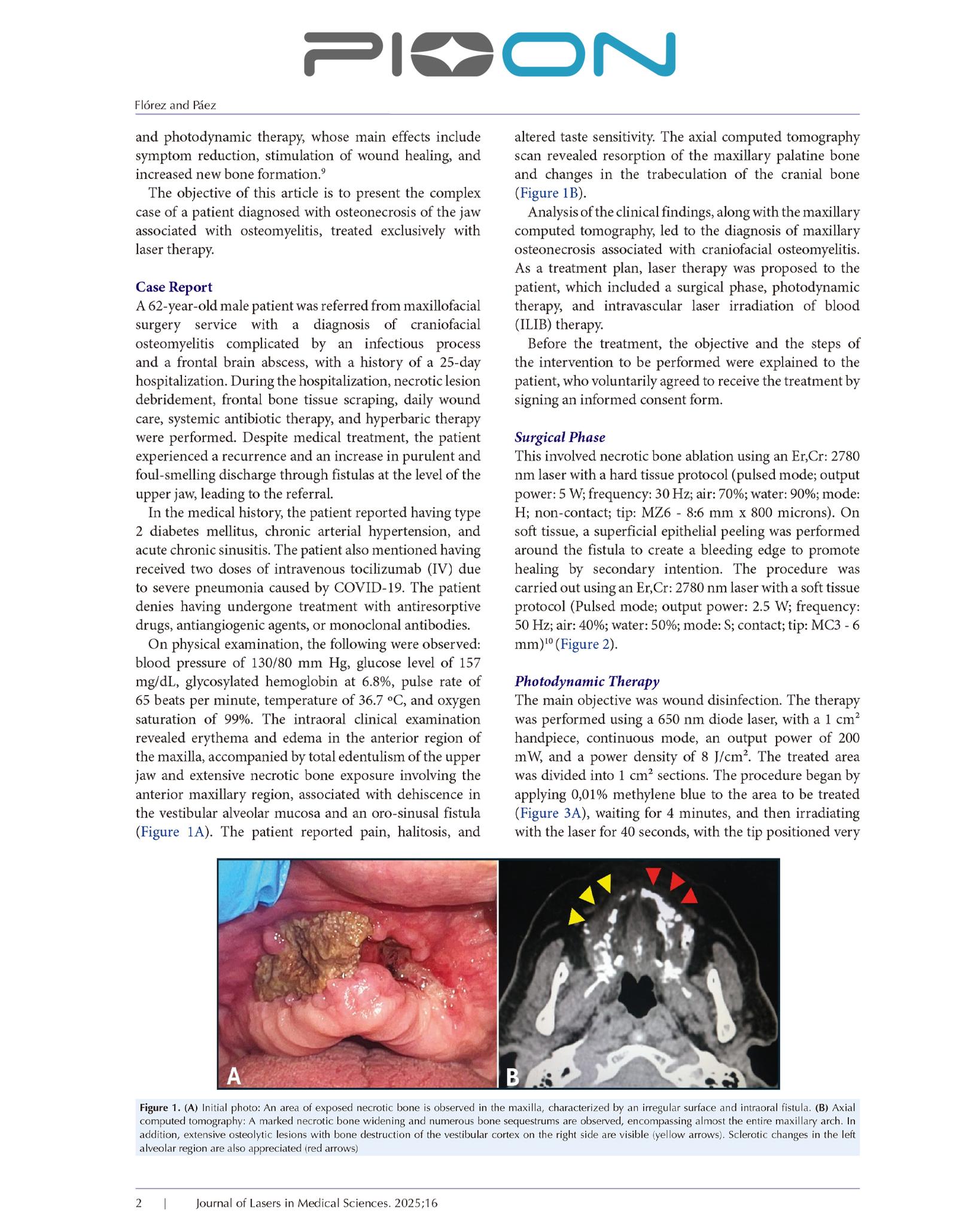 Congrats to Dra Pilar Blanco on Pioneering Laser Study for Maxillary Osteonecrosis