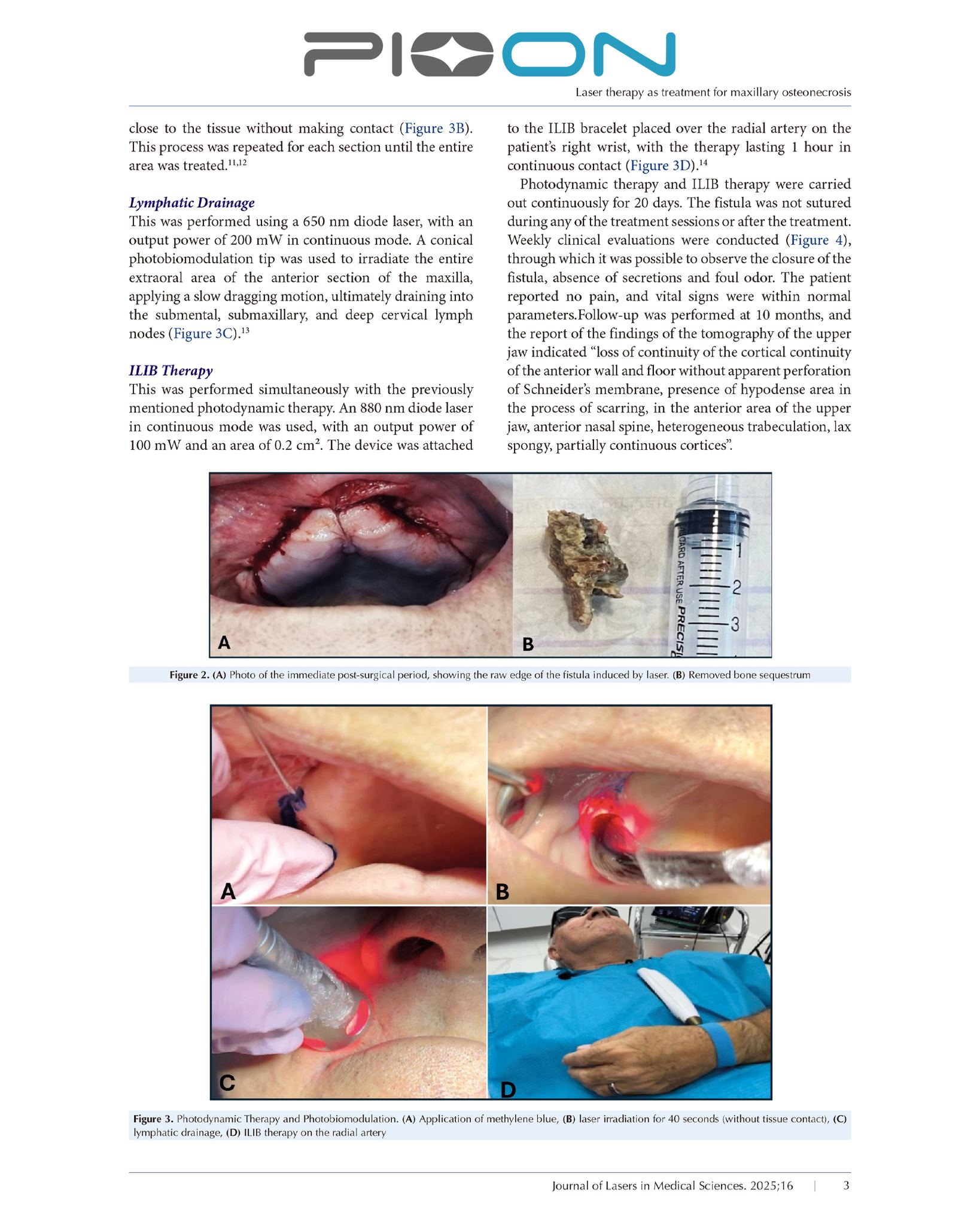 Congrats to Dra Pilar Blanco on Pioneering Laser Study for Maxillary Osteonecrosis