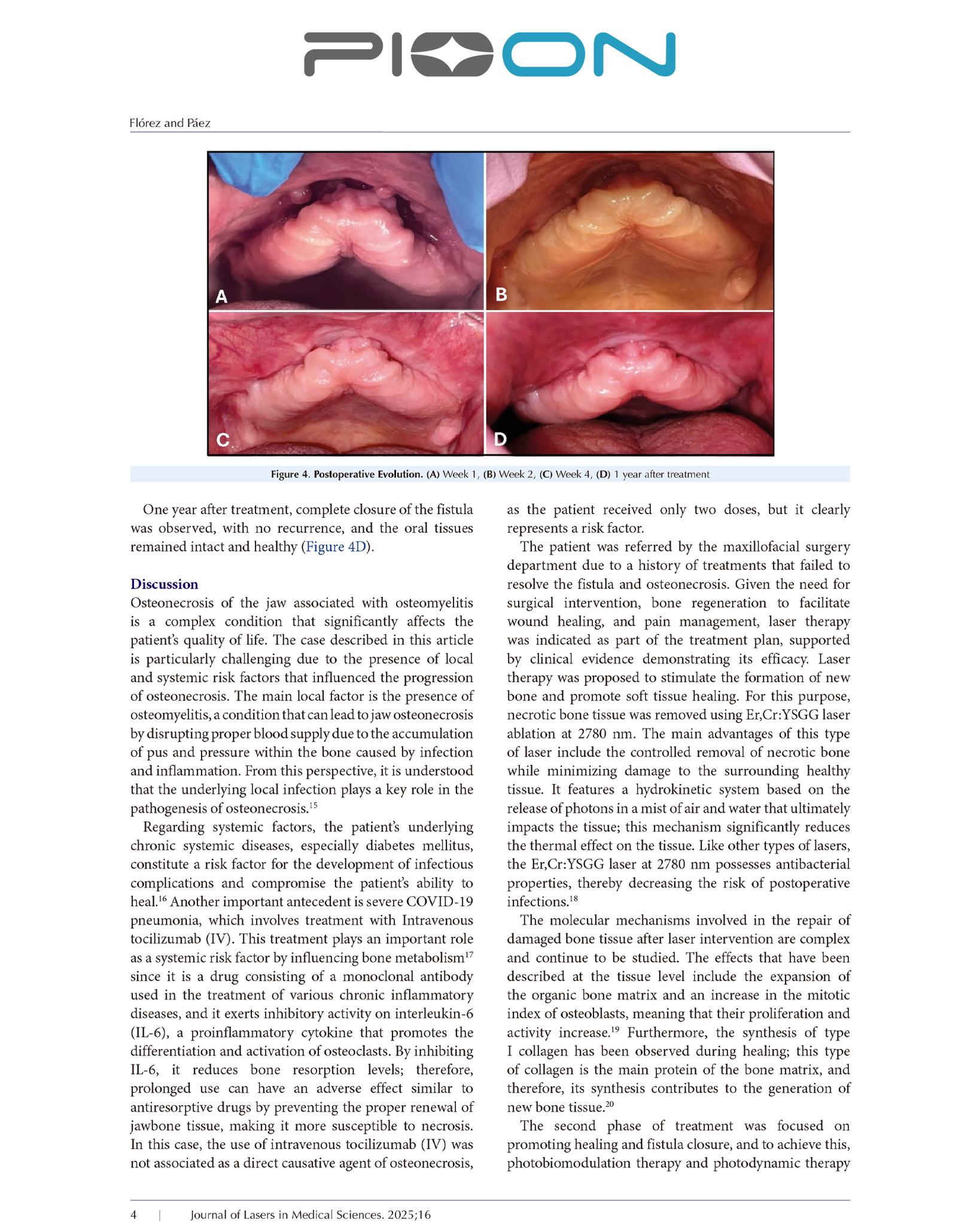 Congrats to Dra Pilar Blanco on Pioneering Laser Study for Maxillary Osteonecrosis