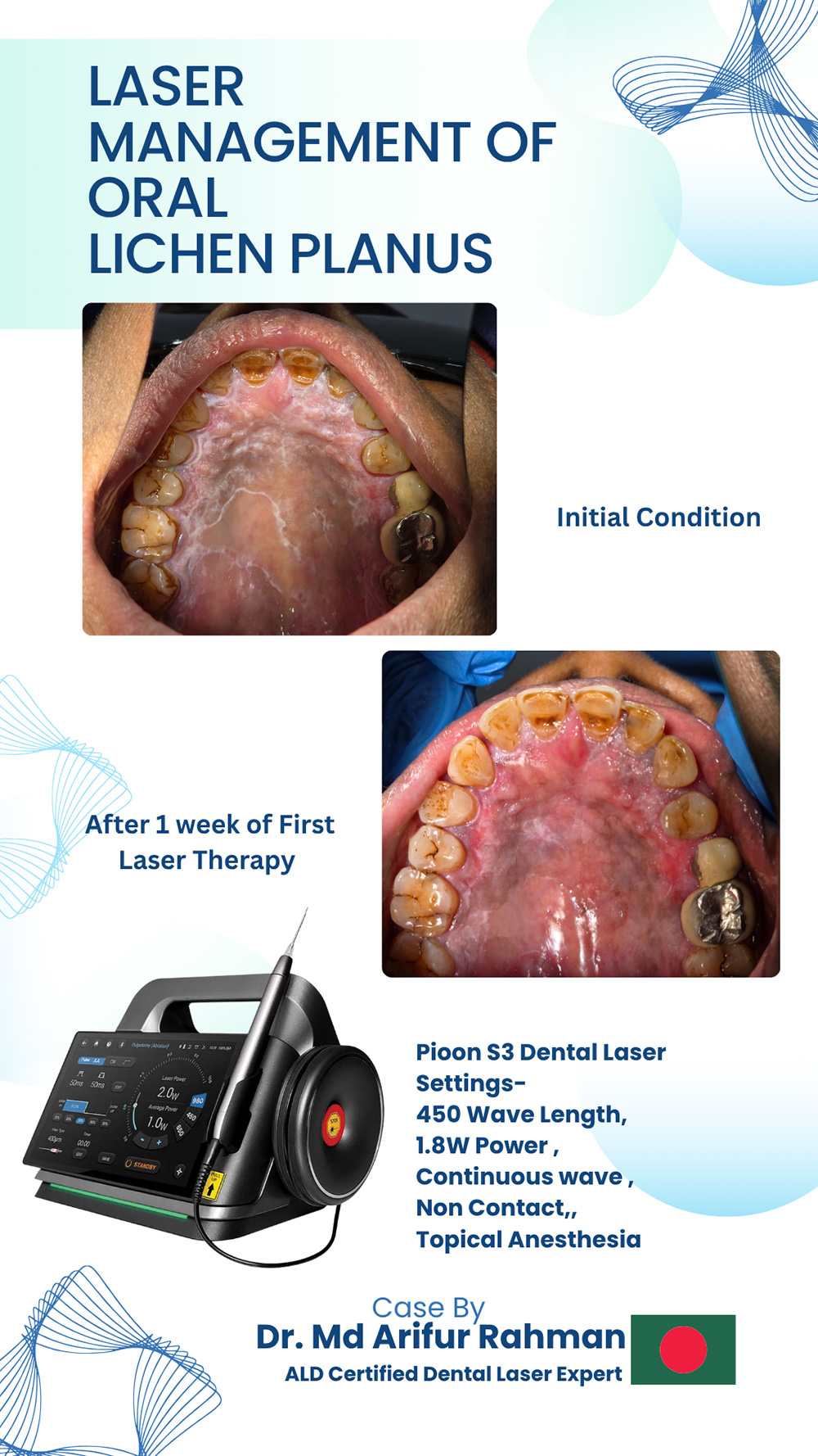 1-Week Laser Relief for Oral Lichen Planus – Case Success in Bangladesh