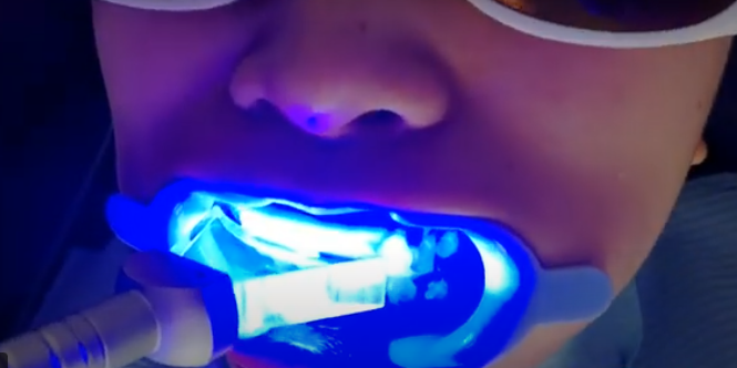 diode-laser-light-teeth-whitening.png diode-laser-light-teeth-whitening.png