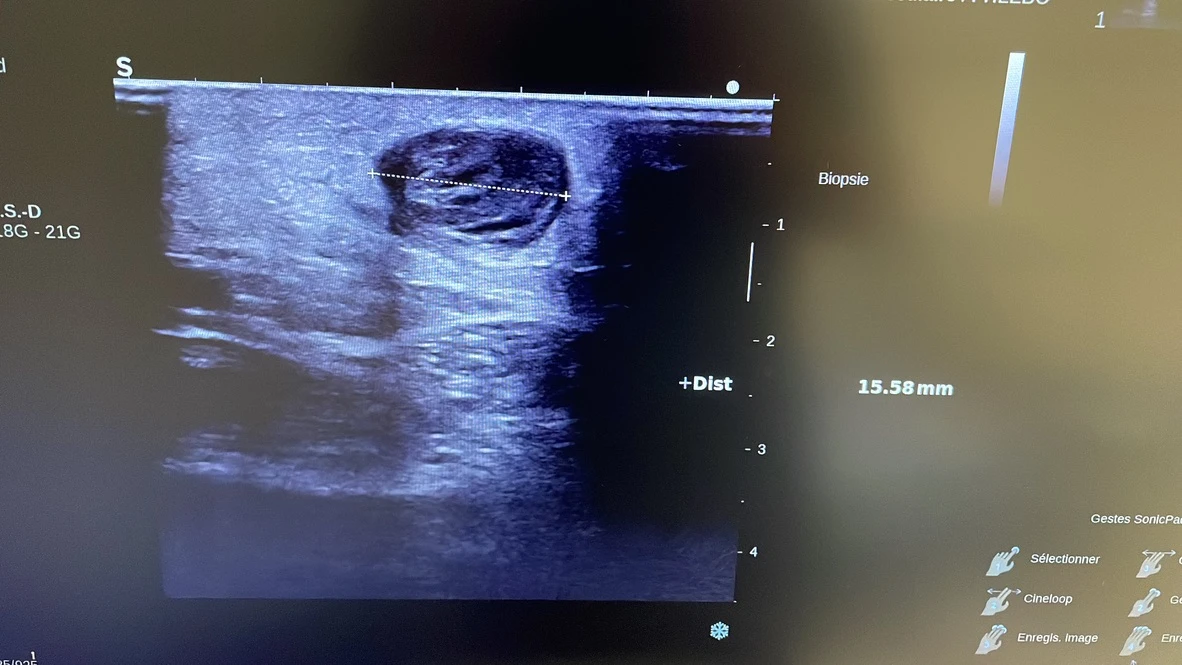 Clinical results of PIOON medical laser and 400 fiber optic
