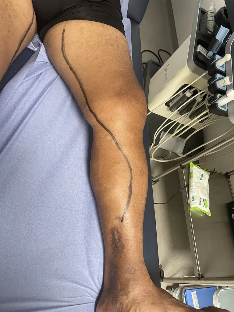 Clinical results of PIOON medical laser and 400 fiber optic