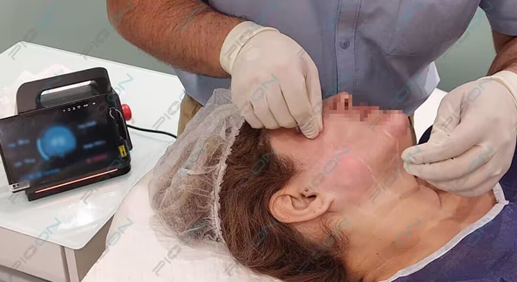 Laser Assisted Face lift