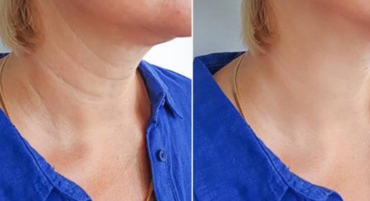 Laser treat Face Swan Neck After treatment