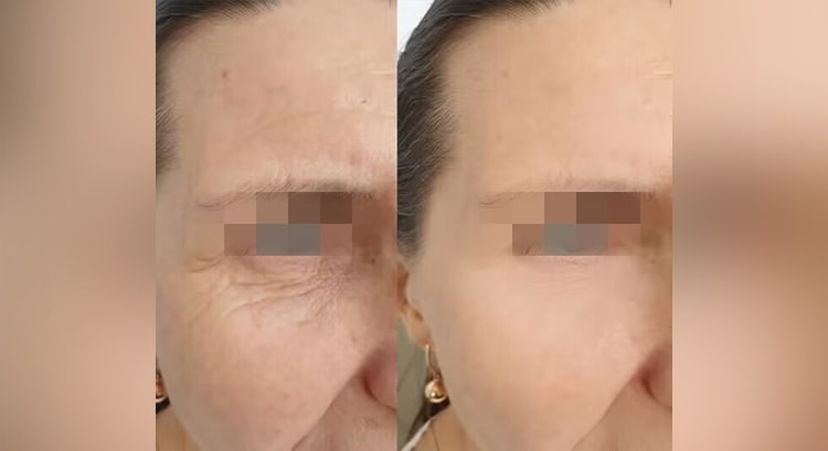 Laser treat Face Wrinkle Lifting