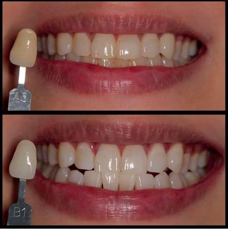 laser teeth whiting