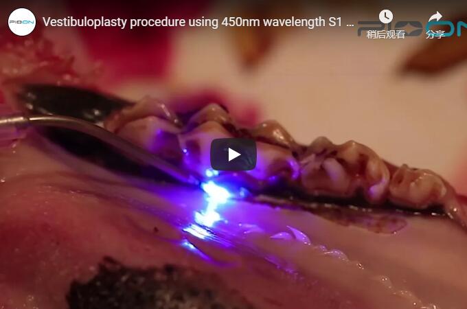 Vestibuloplasty Procedure Using 450nm Wavelength S1 Pioon Laser
