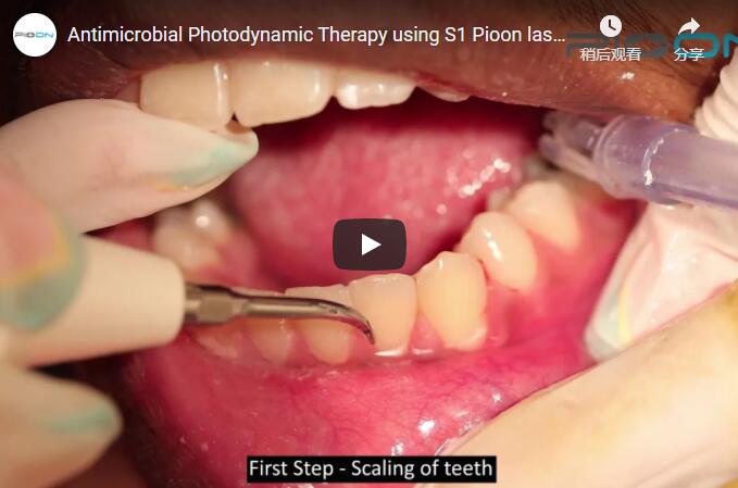 Antimicrobial Photodynamic Therapy using S1 Pioon laser 650nm wavelength