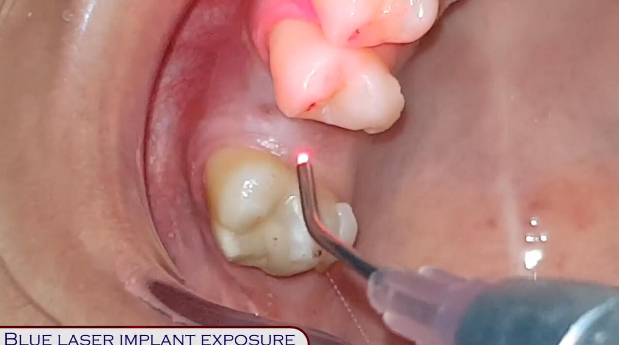 Blue Dental Laser(450nm) Implant Exposure