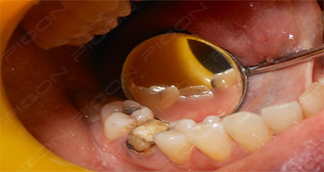 Crown Lengthening Procedure using Dental Diode Laser